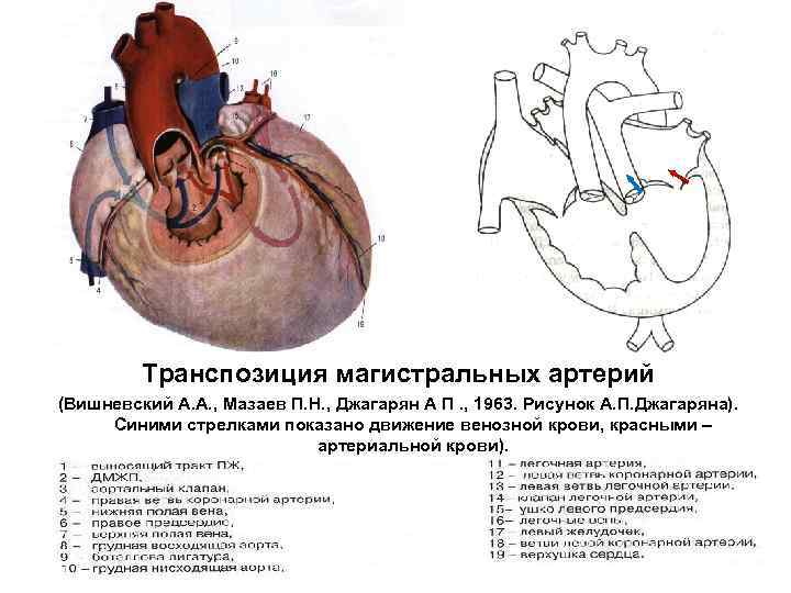 Транспозиция магистральных артерий презентация