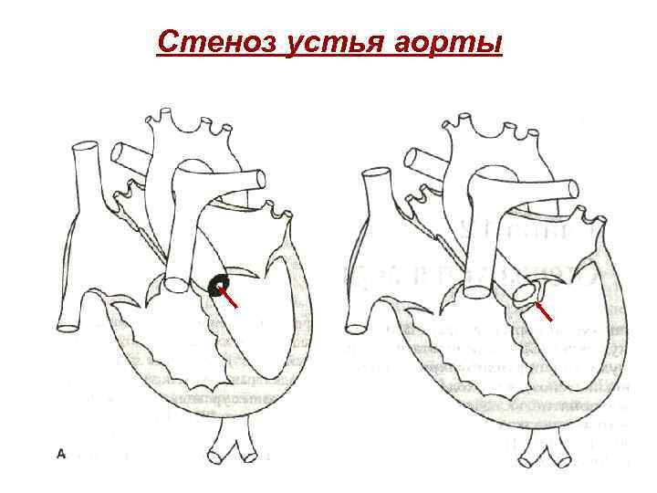 Аортальный стеноз. Аортальный порок сердца стеноз. Врожденные пороки сердца аортальный стеноз. Врожденный стеноз аортального клапана. Врожденный порок сердца, стеноз устья аорты.