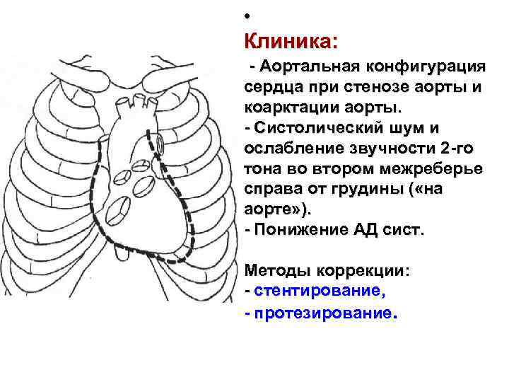 Аортальная конфигурация сердца