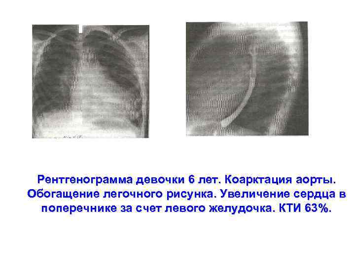 Обогащение легочного рисунка причины