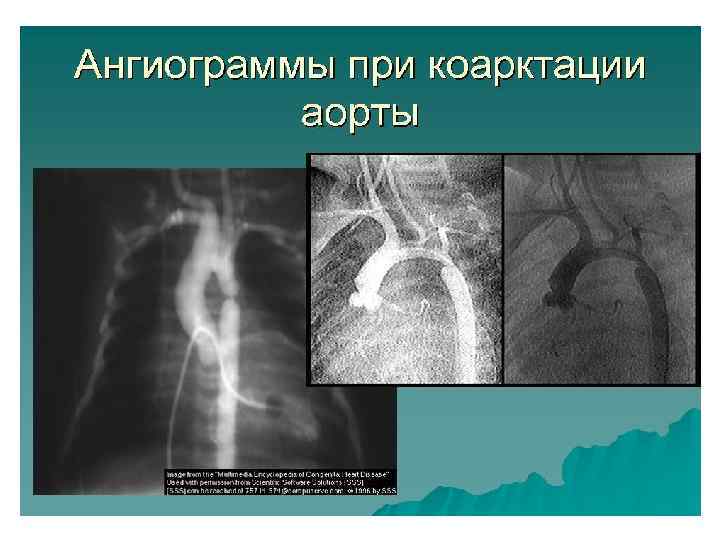 Коарктация аорты фото