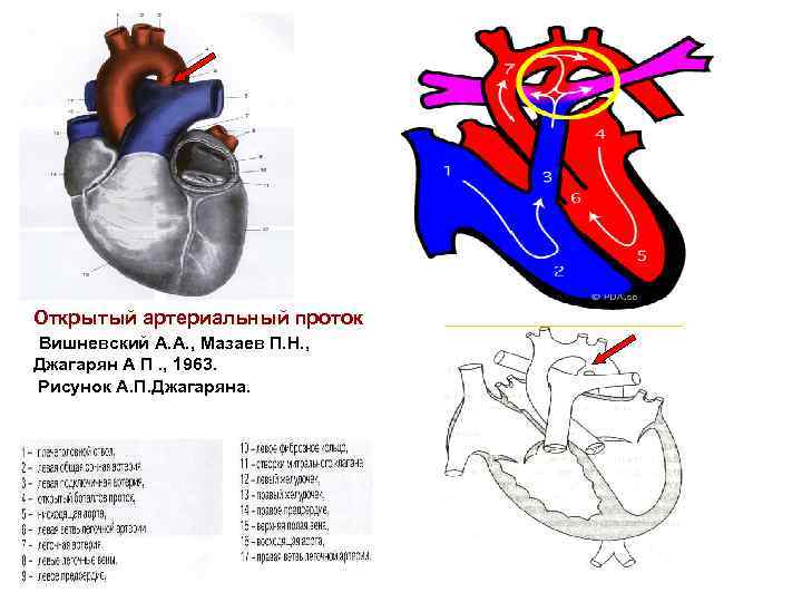 Оап у новорожденных. ВПС открытый артериальный проток у детей. Открытый артериальный проток у новорожденных 1.5мм. Порок сердца открытый артериальный проток. Открытый артериальный проток (ОАП).