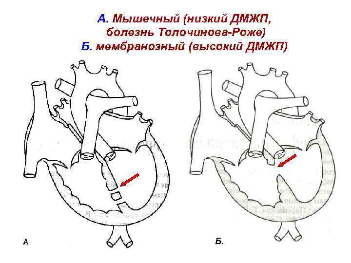 Дефект межжелудочковой перегородки гемодинамика схема