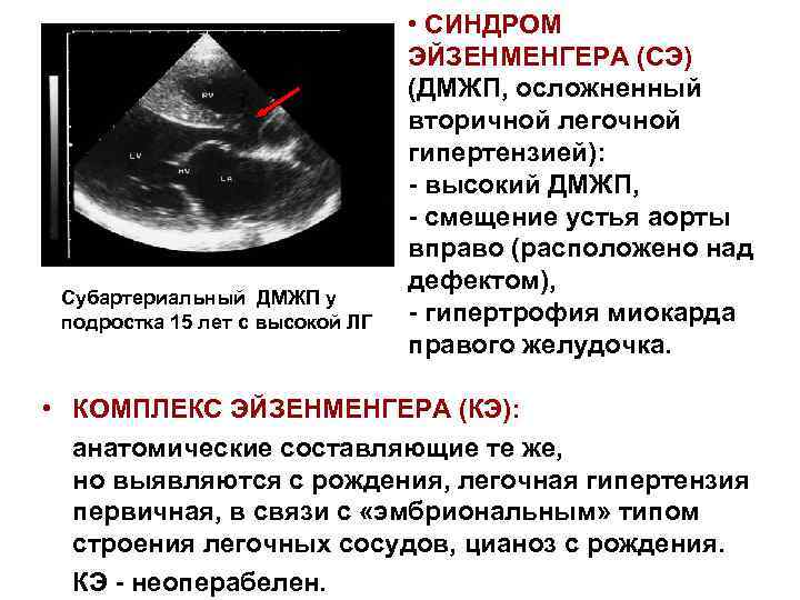 Синдром эйзенменгера презентация