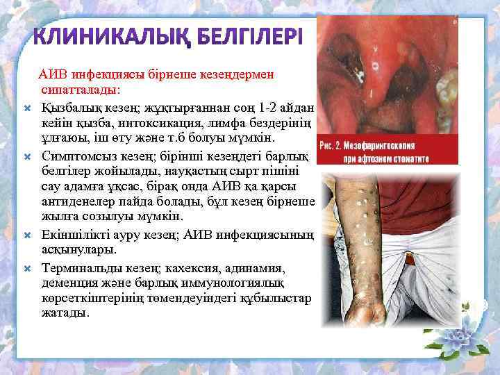  АИВ инфекциясы бірнеше кезеңдермен сипатталады: Қызбалық кезең; жұқтырғаннан соң 1 2 айдан кейін