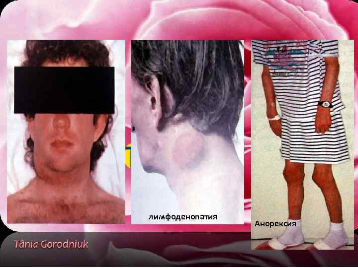 лимфоденопатия Анорексия 