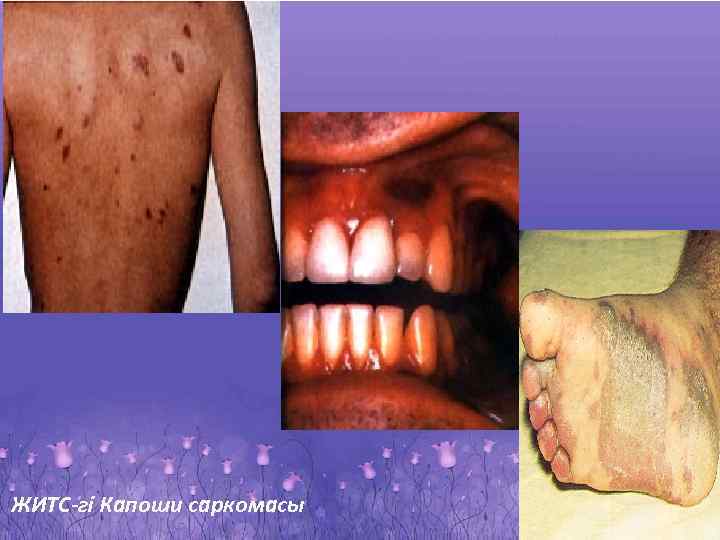 ЖИТС-гі Капоши саркомасы 