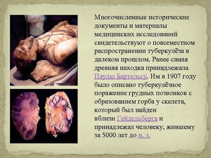 Многочисленные исторические документы и материалы медицинских исследований свидетельствуют о повсеместном распространении туберкулёза в далеком