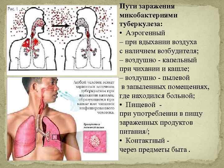 Пути заражения микобактериями туберкулеза: • Аэрогенный – при вдыхании воздуха с наличием возбудителя; –