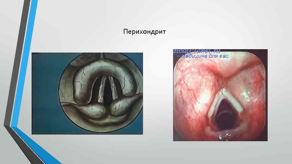 Перихондрит 