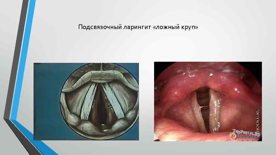 Подсвязочный ларингит «ложный круп» 