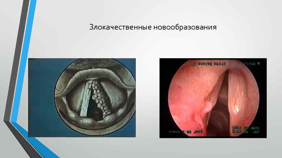 Злокачественные новообразования 