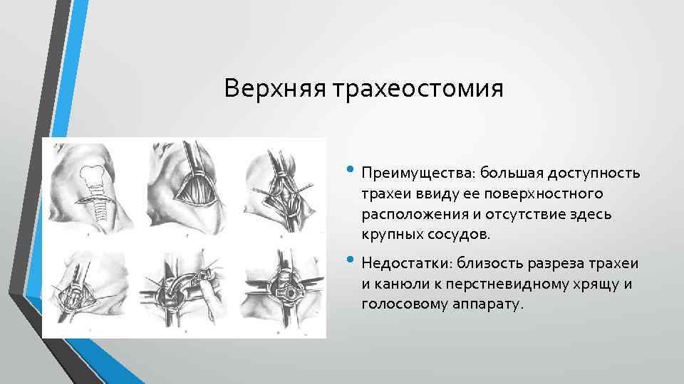 Верхняя трахеостомия • Преимущества: большая доступность трахеи ввиду ее поверхностного расположения и отсутствие здесь