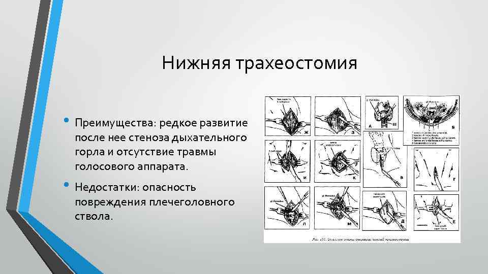 Нижняя трахеостомия • Преимущества: редкое развитие после нее стеноза дыхательного горла и отсутствие травмы