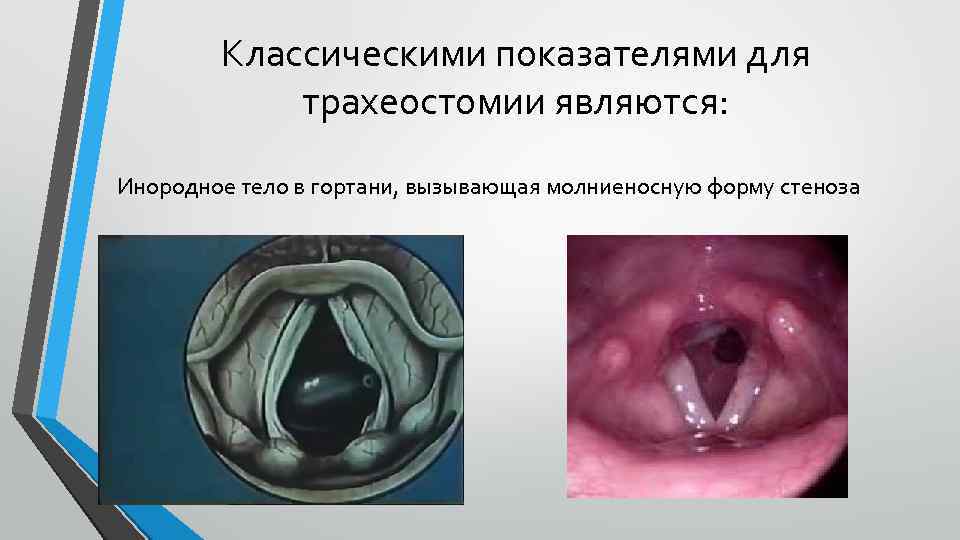 Классическими показателями для трахеостомии являются: Инородное тело в гортани, вызывающая молниеносную форму стеноза 