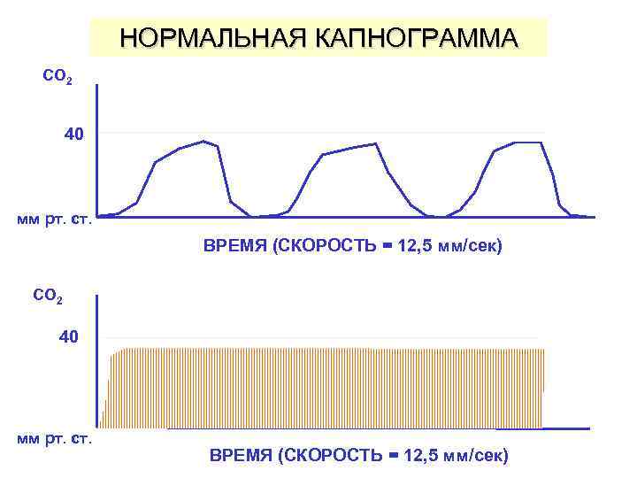 НОРМАЛЬНАЯ КАПНОГРАММА CO 2 40 мм рт. ст. ВРЕМЯ (СКОРОСТЬ = 12, 5 мм/сек)