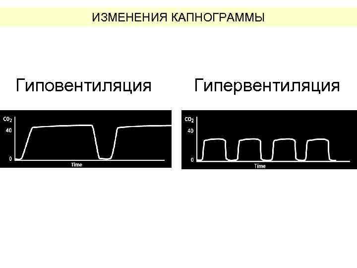 ИЗМЕНЕНИЯ КАПНОГРАММЫ Гиповентиляция Гипервентиляция 