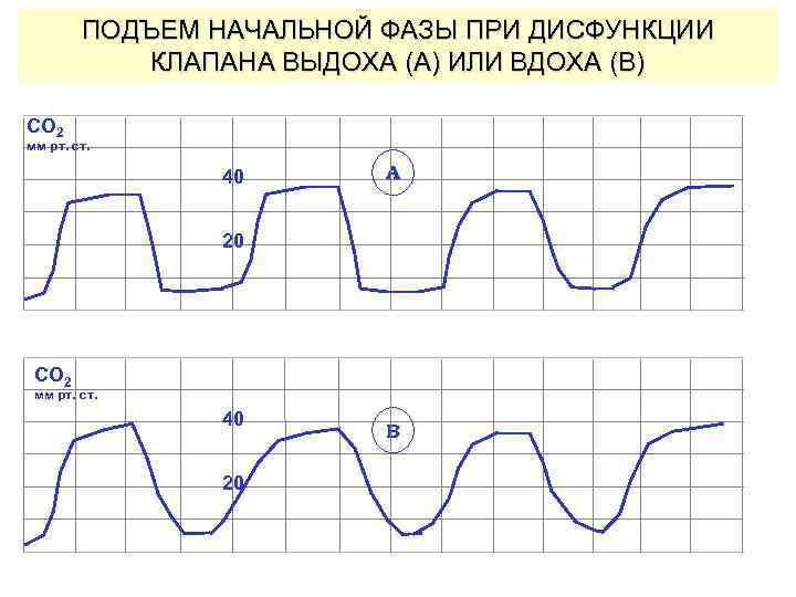 ПОДЪЕМ НАЧАЛЬНОЙ ФАЗЫ ПРИ ДИСФУНКЦИИ КЛАПАНА ВЫДОХА (A) ИЛИ ВДОХА (B) CO 2 мм