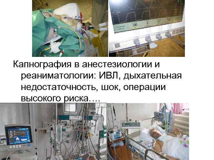 Капнография в анестезиологии и реаниматологии: ИВЛ, дыхательная недостаточность, шок, операции высокого риска…. 