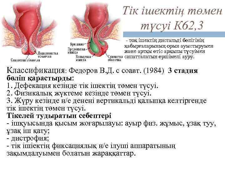 Тік ішектің төмен түсуі К 62, 3 - тоқ ішектің дистальді бөлігінің қабырғаларының орын