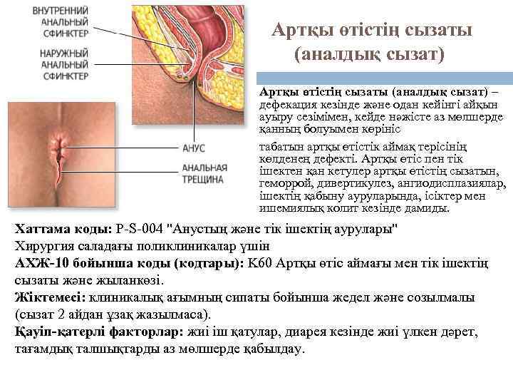 Артқы өтістің сызаты (аналдық сызат) – дефекация кезінде және одан кейінгі айқын ауыру сезімімен,
