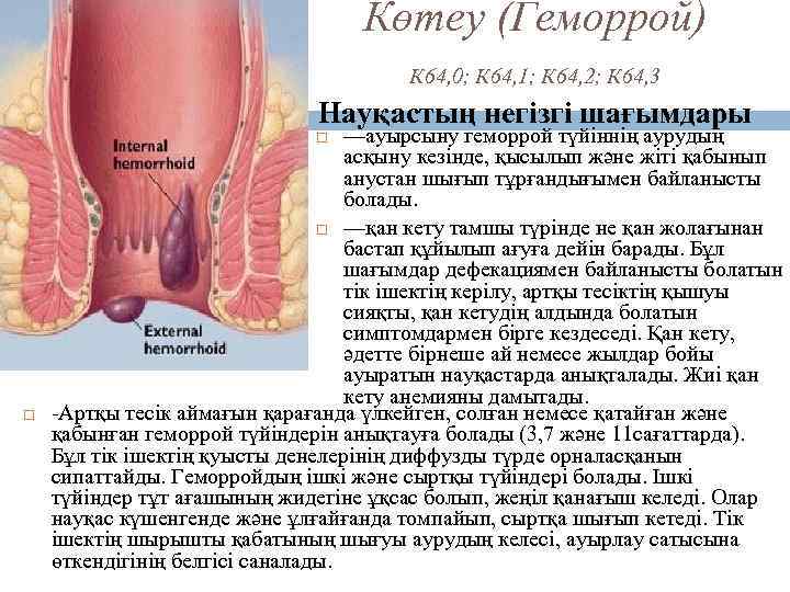 Көтеу (Геморрой) К 64, 0; К 64, 1; К 64, 2; К 64, 3