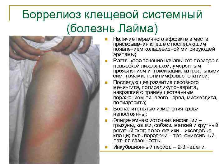Боррелиоз клещевой системный (болезнь Лайма) n n n Наличие первичного аффекта в месте присасывания