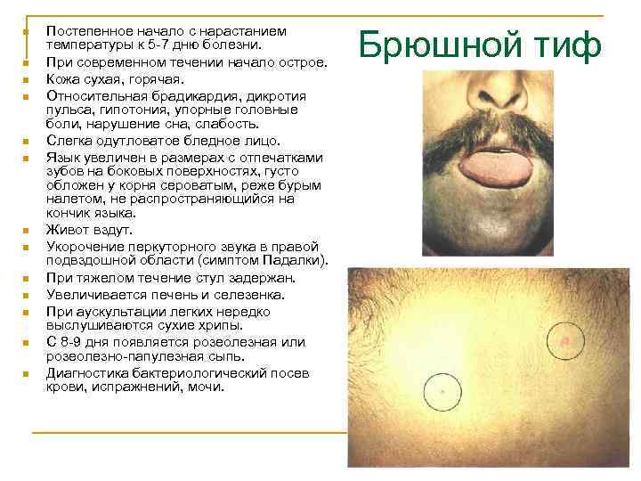 n n n n Постепенное начало с нарастанием температуры к 5 -7 дню болезни.