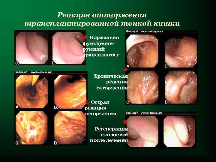 Реакция отторжения трансплантированной тонкой кишки Нормально функционирующий трансплантат Хроническая реакция отторжения Острая реакция отторжения