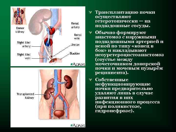 Ú Трансплантацию почки осуществляют гетеротопически — на подвздошные сосуды. Ú Обычно формируют анастомоз с