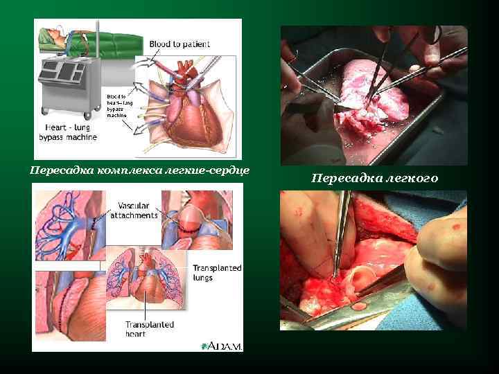 Пересадка комплекса легкие-сердце Пересадка легкого 