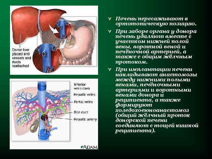 Ú Печень пересаживают в ортотопическую позицию. Ú При заборе органа у донора печень удаляют