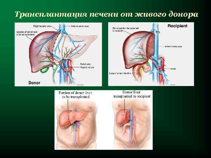 Трансплантация печени от живого донора 