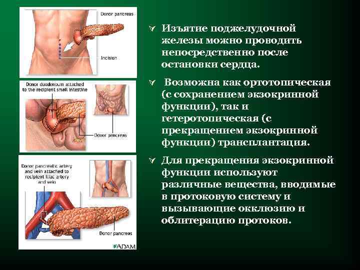 Ú Изъятие поджелудочной железы можно проводить непосредственно после остановки сердца. Ú Возможна как ортотопическая