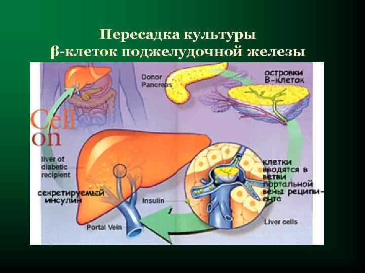 Пересадка культуры β-клеток поджелудочной железы 