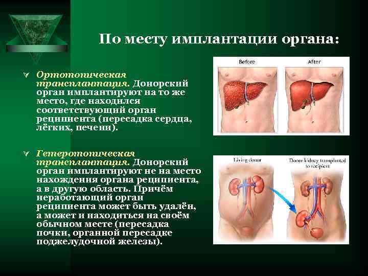 По месту имплантации органа: Ú Ортотопическая трансплантация. Донорский орган имплантируют на то же место,