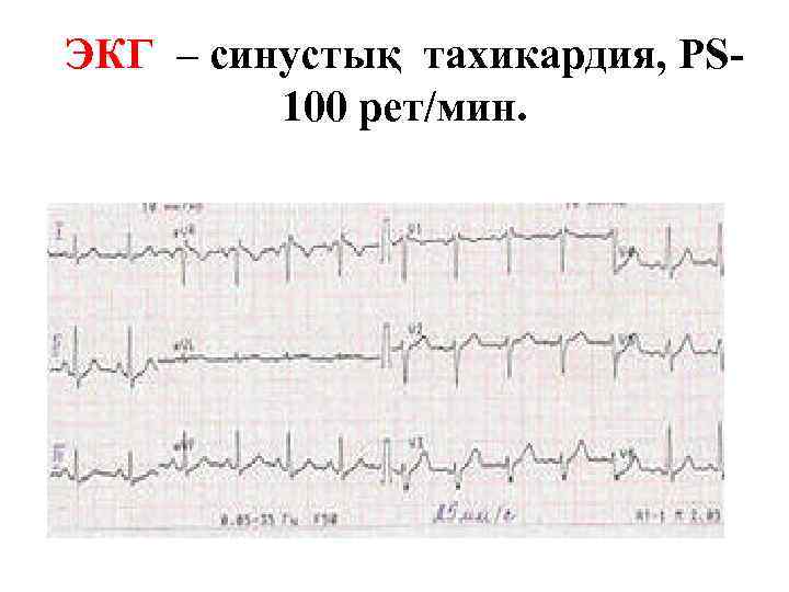 ЭКГ – синустық тахикардия, PS 100 рет/мин. 