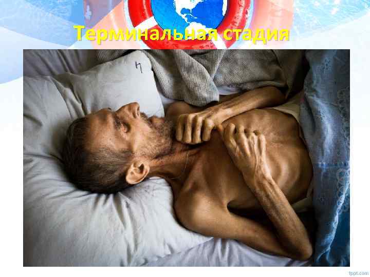 Терминальная стадия 