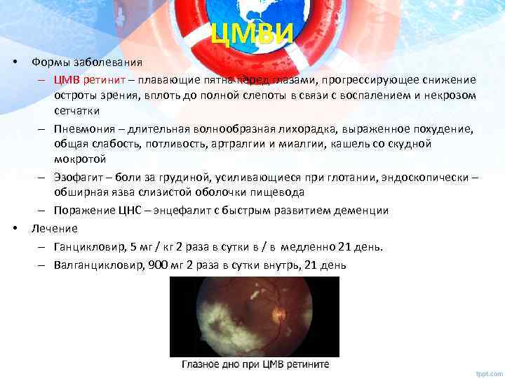ЦМВИ • • Формы заболевания – ЦМВ ретинит – плавающие пятна перед глазами, прогрессирующее