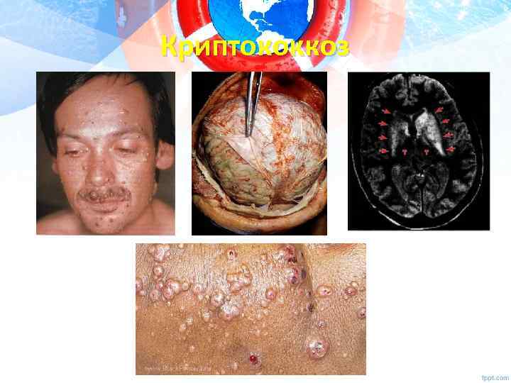 Криптококкоз 