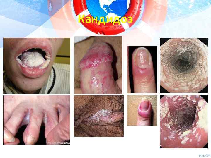 Кандидоз 