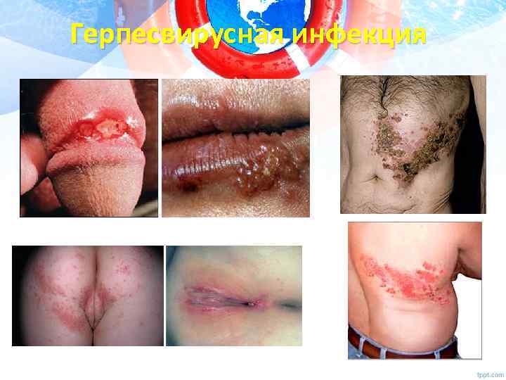 Герпесвирусная инфекция 