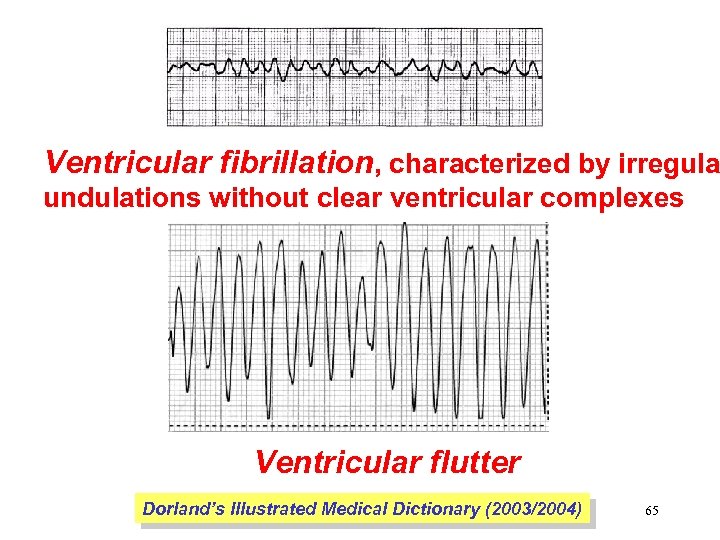 Ventricular fibrillation, characterized by irregula undulations without clear ventricular complexes Ventricular flutter Dorland’s Illustrated