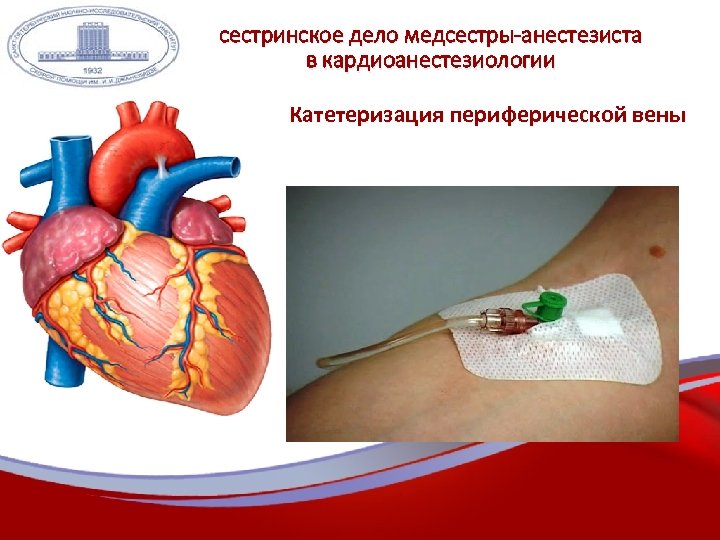 сестринское дело медсестры-анестезиста в кардиоанестезиологии Катетеризация периферической вены 