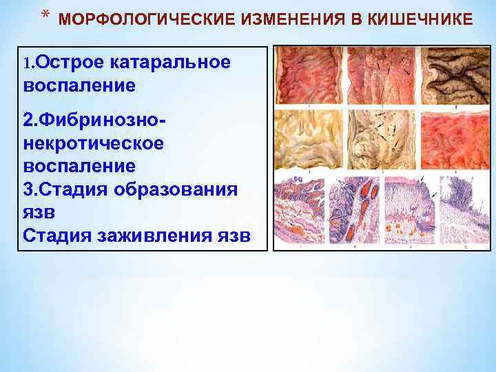 * МОРФОЛОГИЧЕСКИЕ ИЗМЕНЕНИЯ В КИШЕЧНИКЕ 1. Острое катаральное воспаление 2. Фибринознонекротическое воспаление 3. Стадия