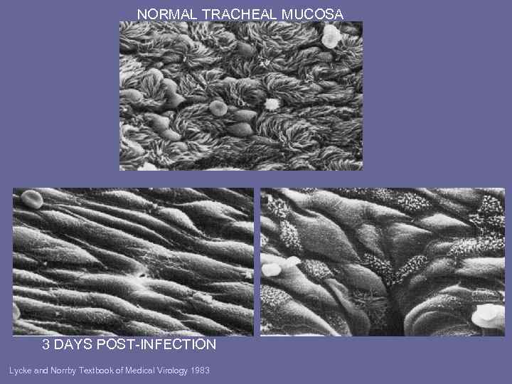 NORMAL TRACHEAL MUCOSA 3 DAYS POST-INFECTION Lycke and Norrby Textbook of Medical Virology 1983