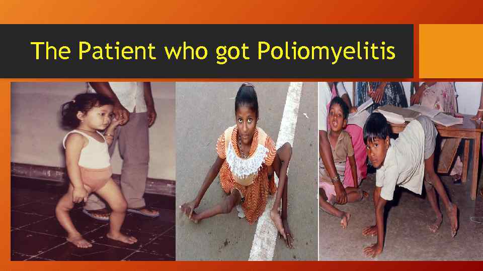 The Patient who got Poliomyelitis 