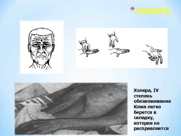 * ХОЛЕРА Холера, IV степень обезвоживания Кожа легко берется в складку, которая не расправляется