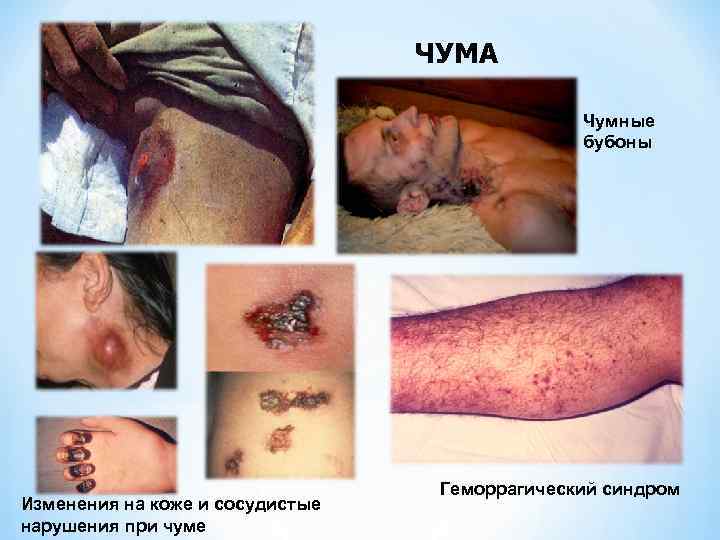 ЧУМА Чумные бубоны Изменения на коже и сосудистые нарушения при чуме Геморрагический синдром 