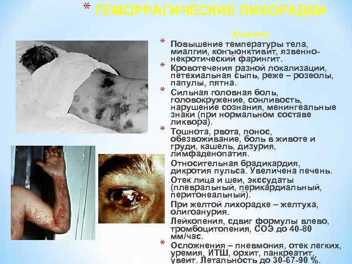 * ГЕМОРРАГИЧЕСКИЕ ЛИХОРАДКИ * * * * * Клиника Повышение температуры тела, миалгии, конъюнктивит,
